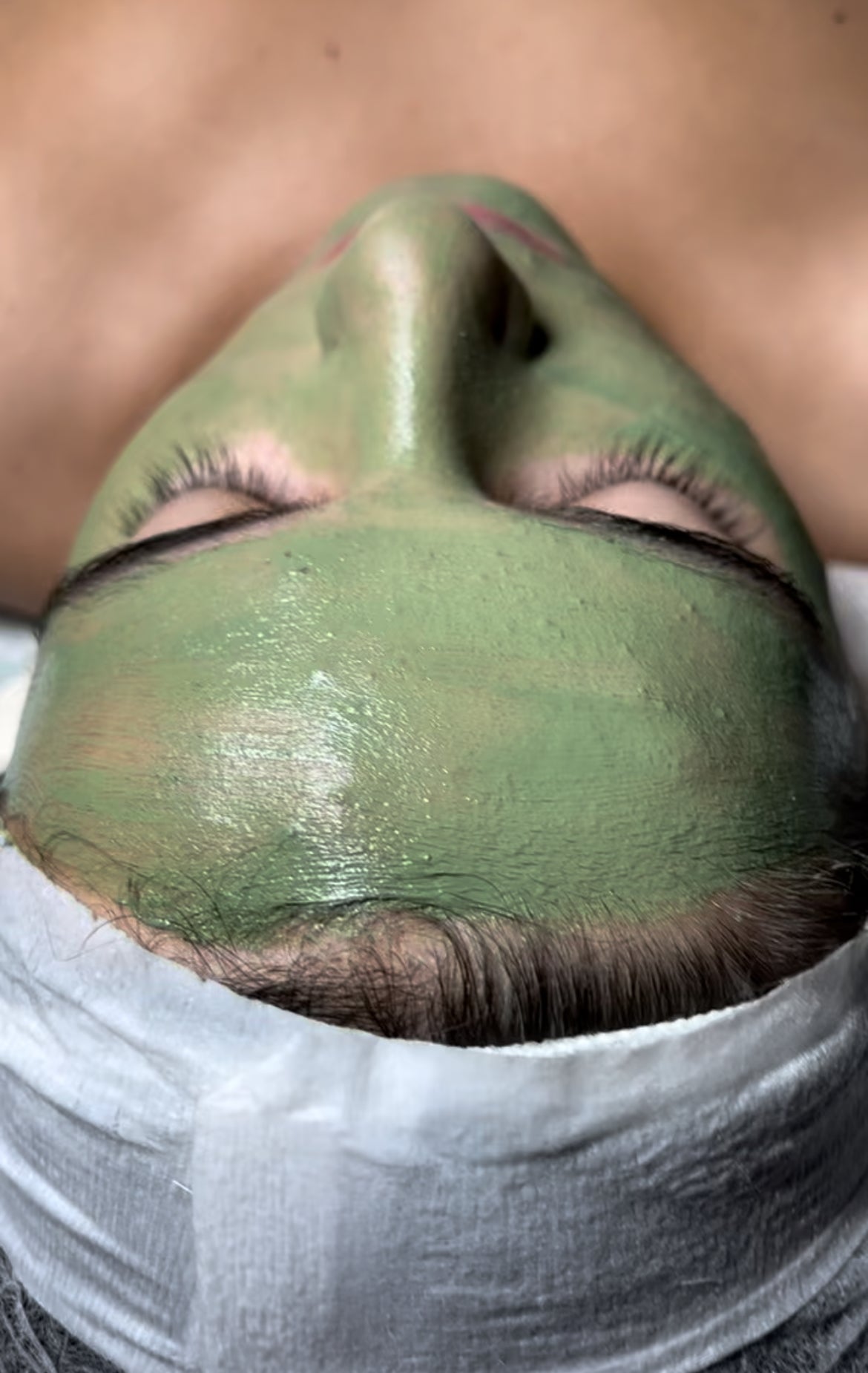 Servicio Tratamiento Acne Facial