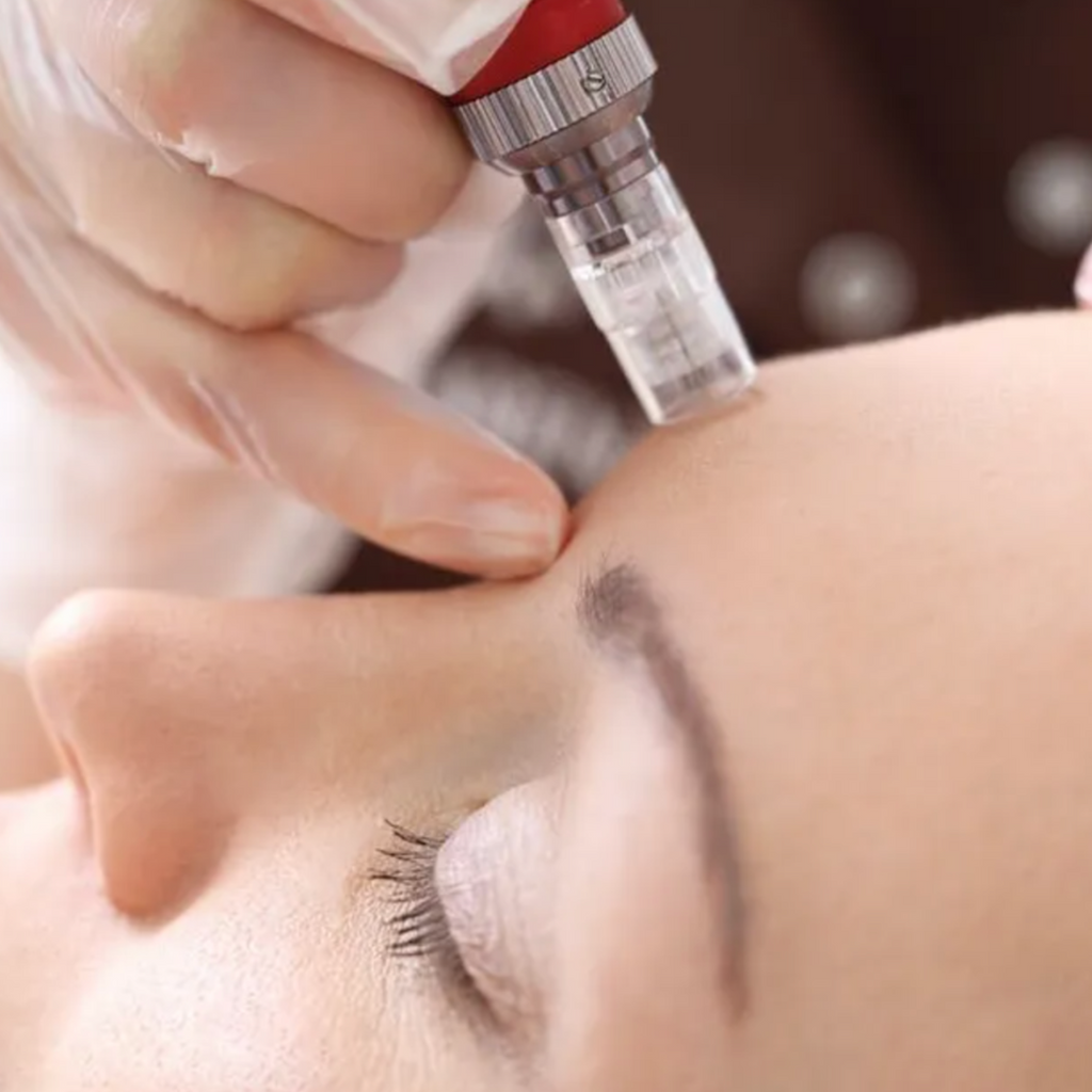 Facial Renew Microneedling - Microinfusion Toskani